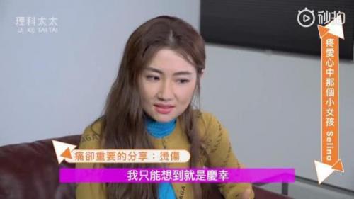 Selina坦然烧伤后8年不怕伤痛反扑 粉丝赞她坚强了