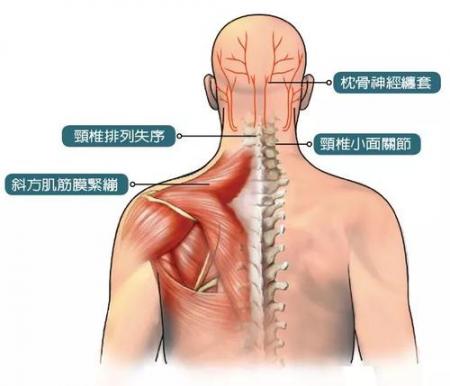  劲椎病的症状与治疗 互联百科 第1张