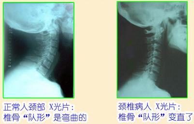  劲椎病的症状与治疗 互联百科 第2张